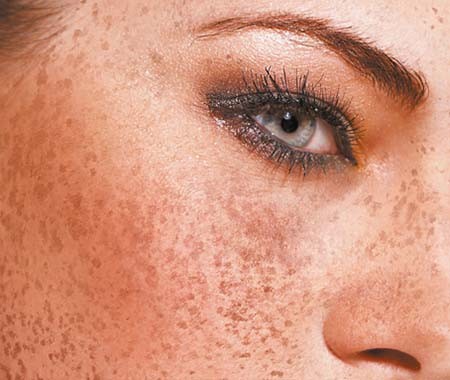 Pigmentvlekken in mijn gezicht! Nee!